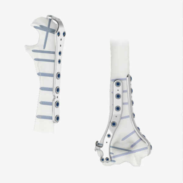 plaques-humerus-distal-oleocrance_intrauma_2026