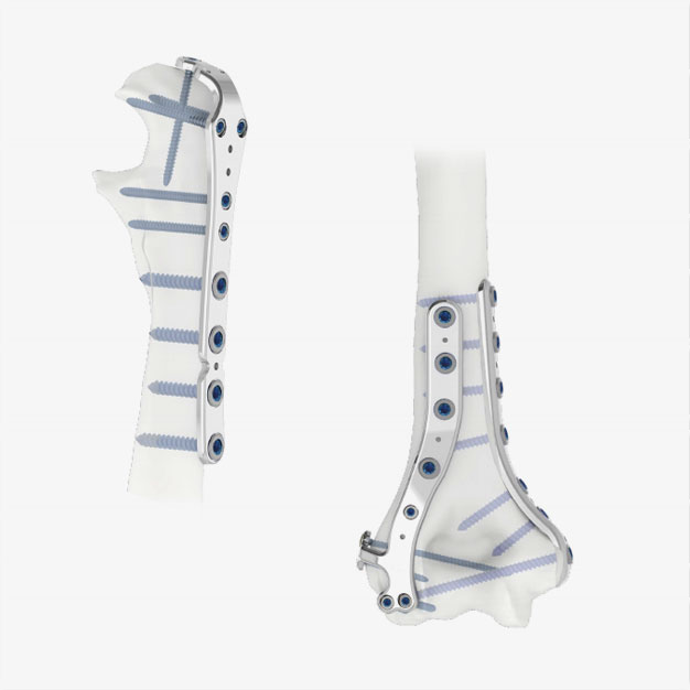 Plaques humérus distal Olécrâne – INTRAUMA®