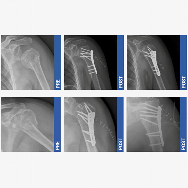 plaques-humerus-proximal_3_intrauma_2026